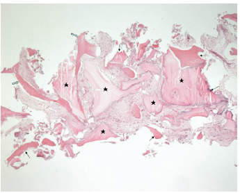 Analysis of the healing process in sinus bone grafting using various graftin 