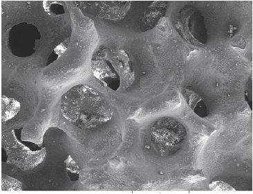 Case series of maxillary sinus augmentation with biphasic calcium phosphate  