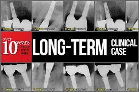 A 10-Year Retrospective Radiograpic Study of Implantium Dental Implants